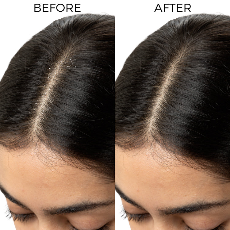 Lactylate Shampoo To Reduce Dandruff