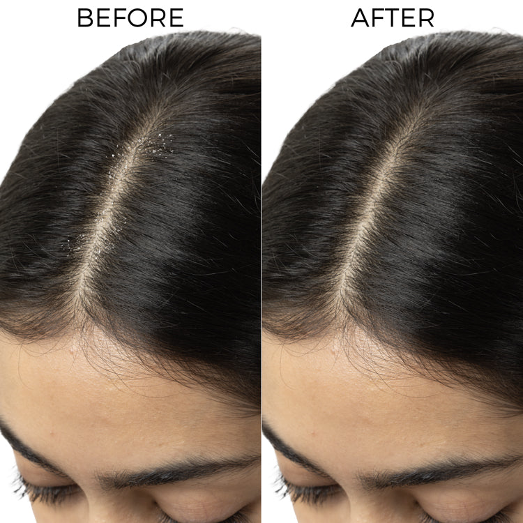 Lactylate & Piroctone Olamine Scalp Serum for Dandruff Control