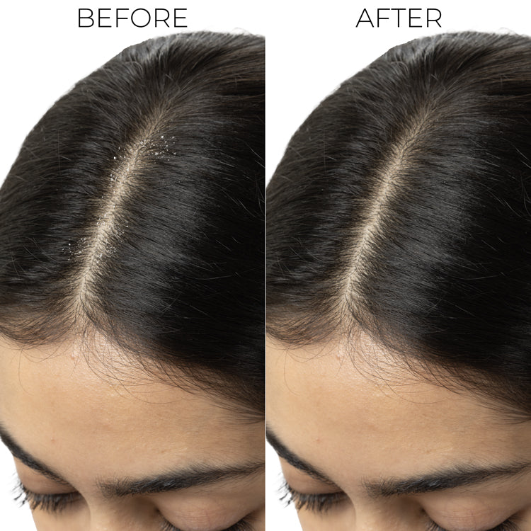 Mini Lactylate Scalp Serum for Dandruff Control (5ml)