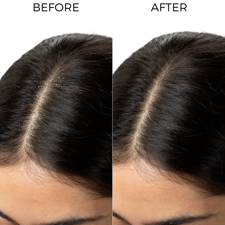 Tea Tree Anti Dandruff Shampoo