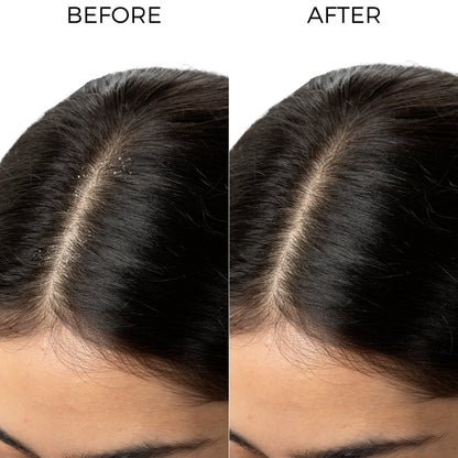 Tea Tree Anti Dandruff Shampoo