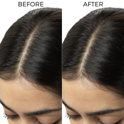 Tea Tree &amp; Salicylic Oil Shots For Dandruff Control
