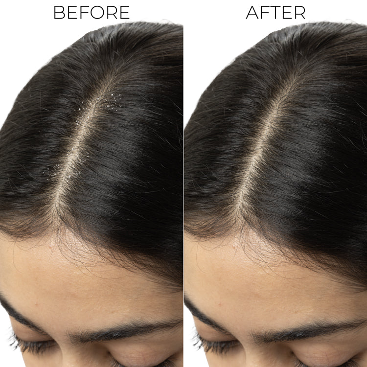 Dandruff Control Shampoo For Itchy, Flaky Scalp