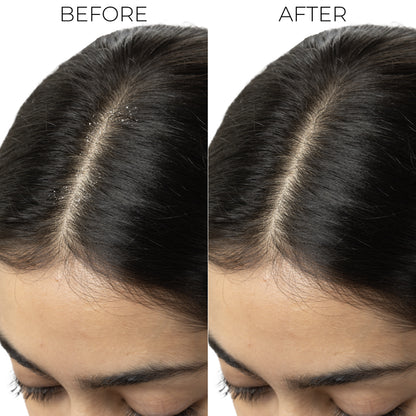 Dandruff Control Shampoo For Itchy, Flaky Scalp